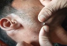 Cystic Acne Extraction Whiteheads