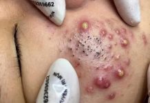 Cystic Acne Blackheads Extraction Whiteheads