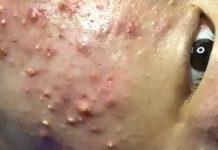 Cystic Acne Blackheads Extraction