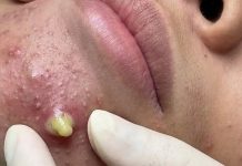 Big Cystic Blackheads Extraction