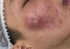 Big Acne Blackheads Extraction