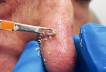 Cystic Blackheads Extraction Removal