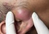 Blackheads Extraction