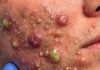 Cystic Acne Blackheads Extraction