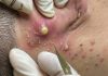 Big Cystic Extraction Whiteheads Removal