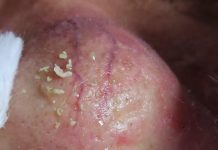 Cystic Extraction Whiteheads