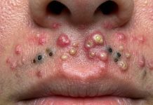 Blackheads Extraction Whiteheads