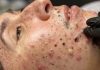 Cystic Acne Blackheads Extraction