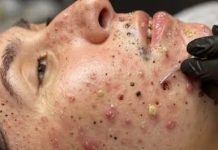 Cystic Acne Blackheads Extraction