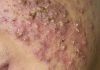 Cystic Acne Blackheads Extraction
