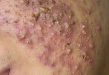 Cystic Acne Blackheads Extraction