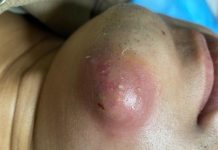 Big Cystic Blackheads Extraction