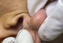 Big Cystic Blackheads