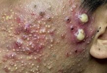 Big Cystic Whiteheads Removal