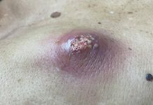 Big Cystic Blackheads Extraction