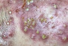 Acne Blackheads Extraction