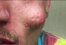 Big Cystic Acne Blackheads Extraction