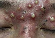 Blackheads Extraction Whiteheads