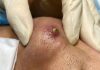 Big Cystic Blackheads