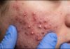 Cystic Acne Blackheads Extraction Whiteheads