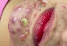 Cystic Acne Extraction Whiteheads