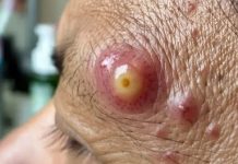 Cystic Extraction milia Whiteheads