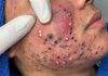 Acne Blackheads Extraction