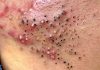 Cystic Blackheads Extraction