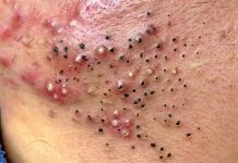 Cystic Blackheads Extraction