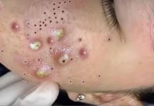 Acne Blackheads Extraction Whiteheads