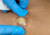 Big Cystic Blackheads Extraction