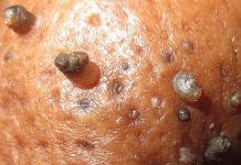 Blackheads Extraction Blackheads