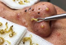 Cystic Blackheads Extraction Removal