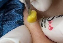 Big Blackheads Extraction