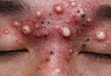 Cystic Blackheads Extraction Whiteheads