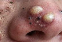 Big Cystic Blackheads Extraction Whiteheads