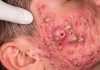 Acne Blackheads Extraction