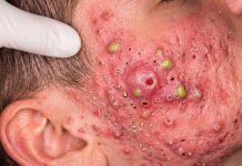 Acne Blackheads Extraction