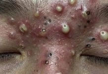 Cystic Blackheads Extraction Whiteheads