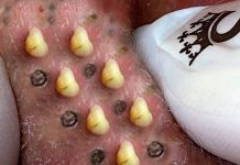 Blackheads Extraction Whiteheads