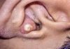 Cystic Blackheads Extraction