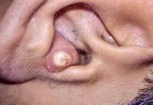Cystic Blackheads Extraction