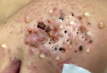 Cystic Acne Blackheads Extraction