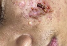 Acne Blackheads Extraction