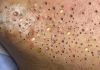 Acne Blackheads Extraction