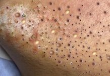 Acne Blackheads Extraction