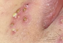 Extraction Whiteheads