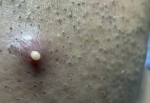 Cystic Extraction Whiteheads