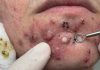 Blackheads Extraction Removal