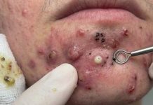 Blackheads Extraction Removal